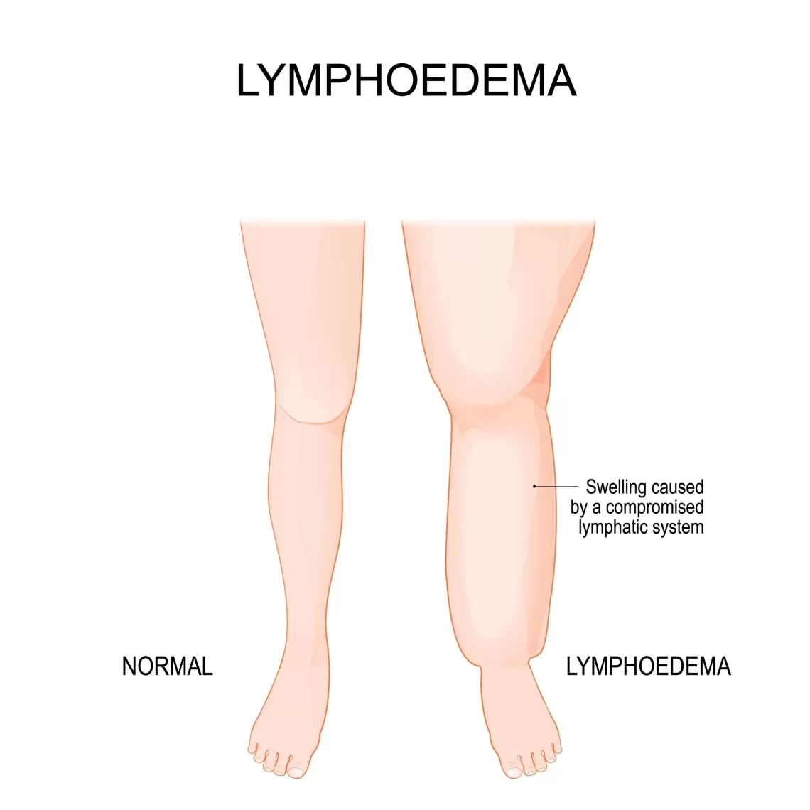 淋巴水腫成「象腿」，-超顯微手術手術助改善！