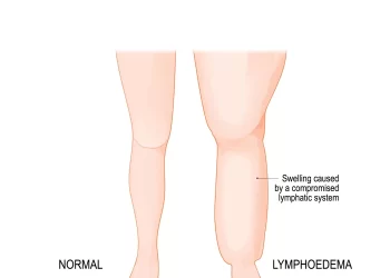 淋巴水腫成「象腿」，-超顯微手術手術助改善！
