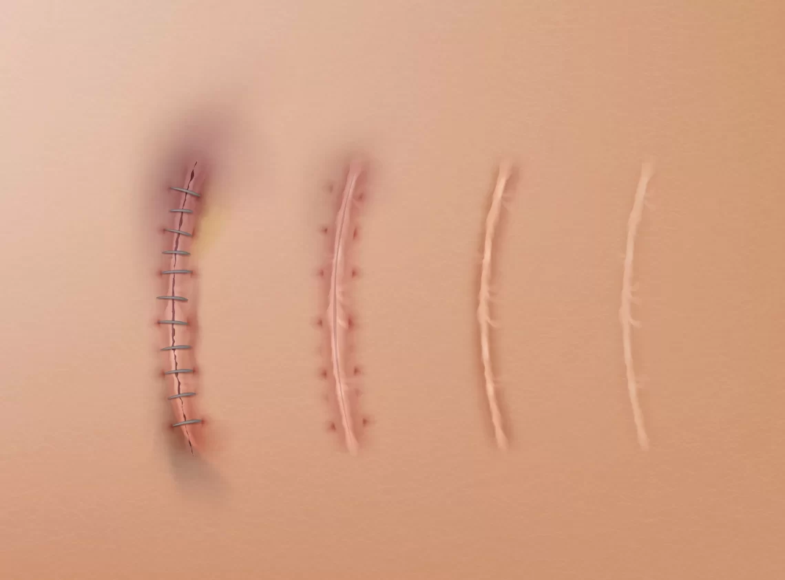 罹癌年輕化-疤痕照護成重要課題!-便宜安全有效方式-報給你知!