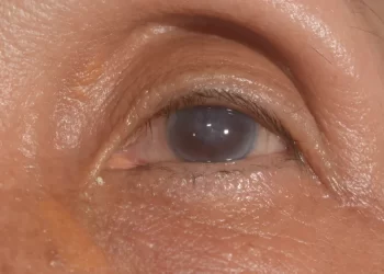 眼角膜水腫不必開大刀！角膜內皮細胞移植挽救失明風險！