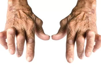 不是只有紅斑性狼瘡，盤點四大常見自體免疫疾病！