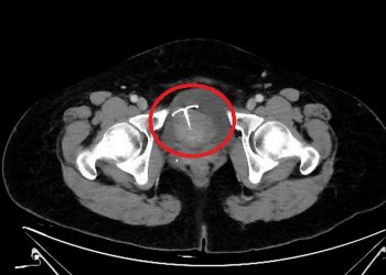 五旬婦腹痛-避孕器竟「穿透子宮」