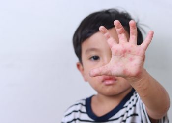 喉嚨潰瘍身上長紅疹，腸病毒「手足口病造成」！出現4大重症前兆速就醫！