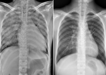 18歲產婦發生罕見「周產期心肌病變」，花蓮慈濟鬼門關前救回！出現哪些症狀要注意！