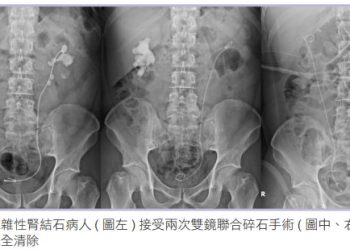 複雜結石的剋星？雙鏡結合碎石術！