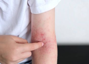 異位性皮膚炎自我照護-食衣住行注意事項一次掌握