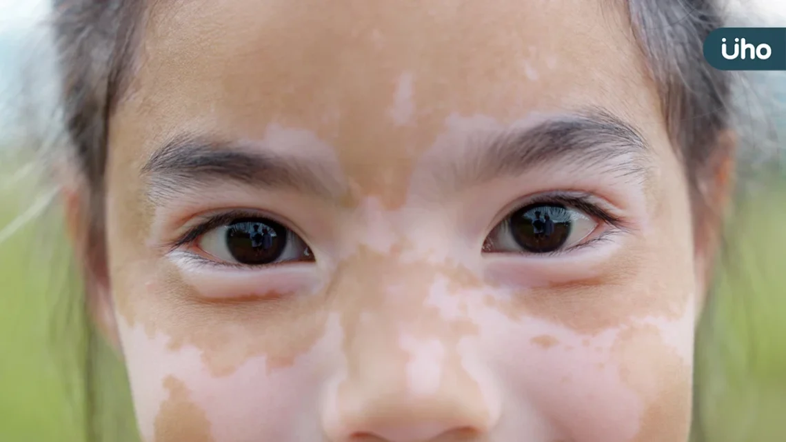 8歲女童患白斑症 醫病共同控制病情