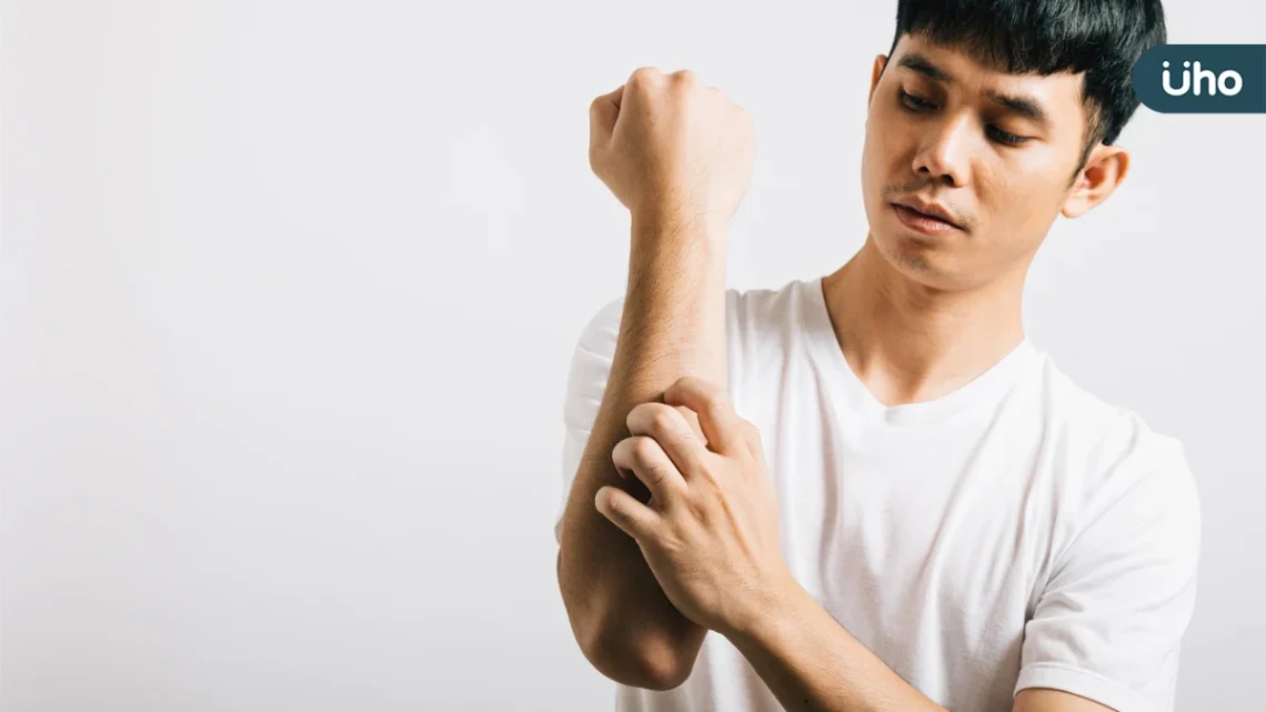 卸下長袖 告別脫皮人生 醫:穩控乾癬避免引發關節炎