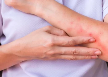 異位性皮膚炎治療新趨勢 生物製劑到生活調適 找回穩定自信