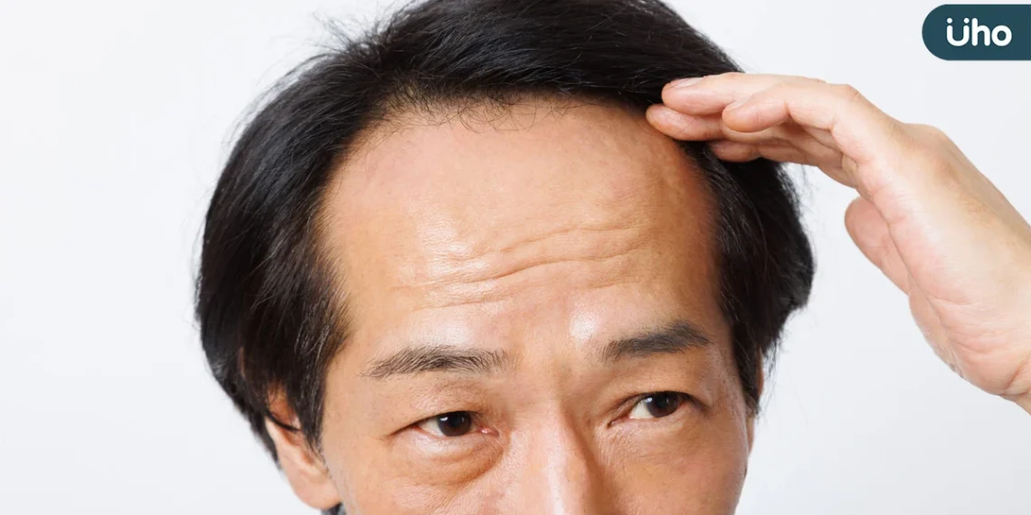落髮不一定只和荷爾蒙有關 醫毛囊微環境失衡也可能讓髮量變少