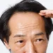 落髮不一定只和荷爾蒙有關 醫毛囊微環境失衡也可能讓髮量變少